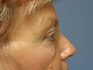 Blepharoplasty Before and After Pictures Nashville, TN