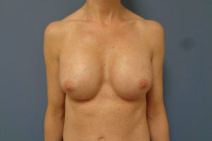 Breast Augmentation Before and After Pictures Nashville, TN