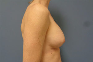 Breast Augmentation Before and After Pictures Nashville, TN