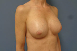 Breast Augmentation Before and After Pictures Nashville, TN