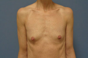 Breast Augmentation Before and After Pictures Nashville, TN