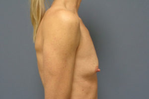 Breast Augmentation Before and After Pictures Nashville, TN