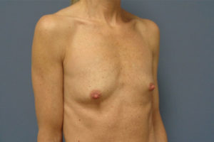 Breast Augmentation Before and After Pictures Nashville, TN