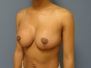 Breast Augmentation with Lift Before and After Pictures Nashville, TN