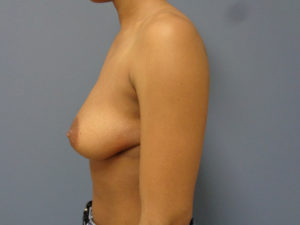 Breast Augmentation with Lift Before and After Pictures Nashville, TN