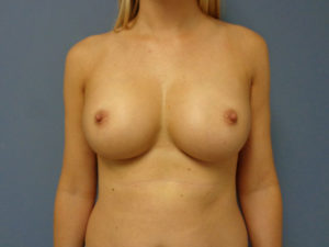 Breast Augmentation Before and After Pictures Nashville, TN