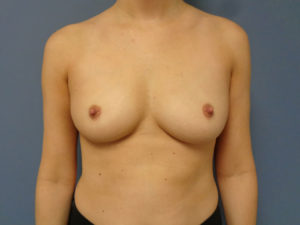 Breast Augmentation Before and After Pictures Nashville, TN