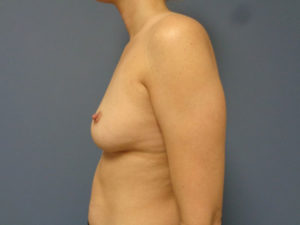 Breast Augmentation Before and After Pictures Nashville, TN