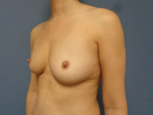 Breast Augmentation Before and After Pictures Nashville, TN