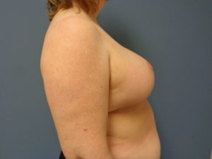 Breast Reduction Before and After Pictures Nashville, TN