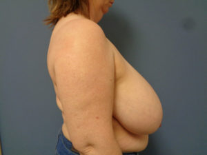 Breast Reduction Before and After Pictures Nashville, TN