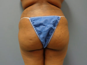 Butt Augmentation Before and After Pictures Nashville, TN