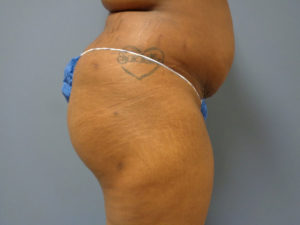 Butt Augmentation Before and After Pictures Nashville, TN