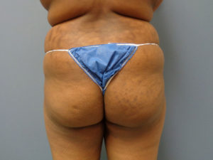 Butt Augmentation Before and After Pictures Nashville, TN