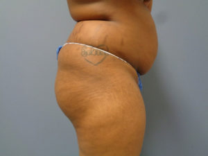 Butt Augmentation Before and After Pictures Nashville, TN