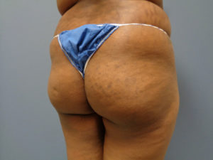 Butt Augmentation Before and After Pictures Nashville, TN