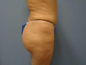 Butt Augmentation Before and After Pictures Nashville, TN