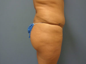 Butt Augmentation Before and After Pictures Nashville, TN