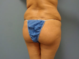 Butt Augmentation Before and After Pictures Nashville, TN