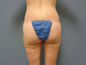 Butt Augmentation Before and After Pictures Nashville, TN