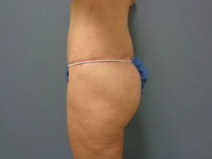 Butt Augmentation Before and After Pictures Nashville, TN