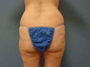 Butt Augmentation Before and After Pictures Nashville, TN