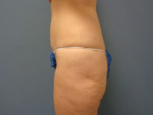 Butt Augmentation Before and After Pictures Nashville, TN