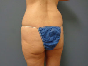 Butt Augmentation Before and After Pictures Nashville, TN