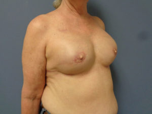 Implant Based Reconstruction Before and After Pictures Nashville, TN