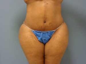 Tummy Tuck Before and After Pictures Nashville, TN