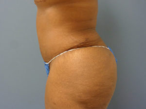 Tummy Tuck Before and After Pictures Nashville, TN