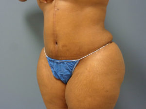 Tummy Tuck Before and After Pictures Nashville, TN