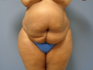 Tummy Tuck Before and After Pictures Nashville, TN