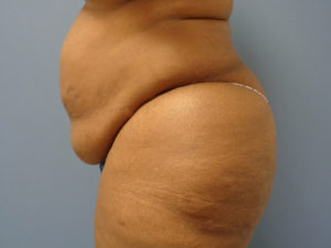 Tummy Tuck Before and After Pictures Nashville, TN