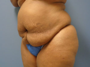 Tummy Tuck Before and After Pictures Nashville, TN