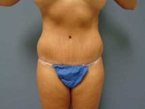 Tummy Tuck Before and After Pictures Nashville, TN