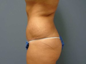 Tummy Tuck Before and After Pictures Nashville, TN