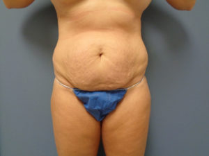 Tummy Tuck Before and After Pictures Nashville, TN