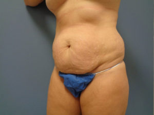 Tummy Tuck Before and After Pictures Nashville, TN