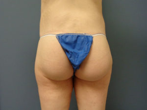 Butt Augmentation Before and After Pictures Nashville, TN