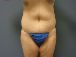 Body Lift Before & After Pictures in Nashville, TN