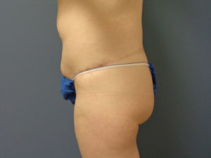 Butt Augmentation Before and After Pictures Nashville, TN