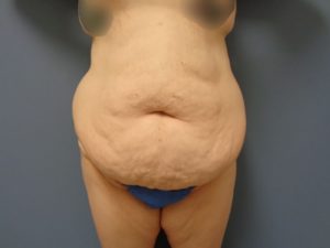 Body Lift Before & After Pictures in Nashville, TN