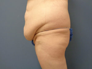 Butt Augmentation Before and After Pictures Nashville, TN