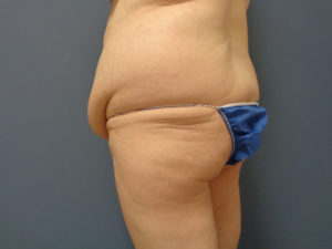 Butt Augmentation Before and After Pictures Nashville, TN