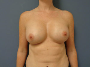 Breast Augmentation Before and After Pictures Nashville, TN