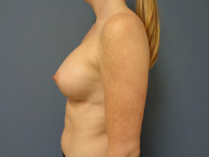 Breast Augmentation Before and After Pictures Nashville, TN