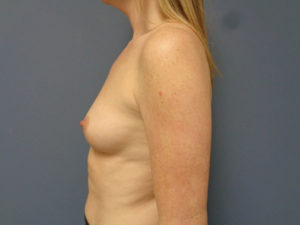 Breast Augmentation Before and After Pictures Nashville, TN