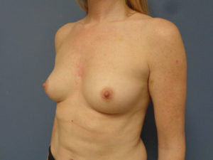 Breast Augmentation Before & After Pictures in Nashville, TN