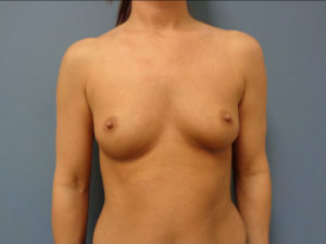 Breast Augmentation Before and After Pictures Nashville, TN